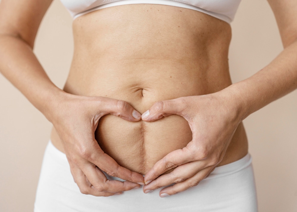 Eliminar cicatrices del abdomen